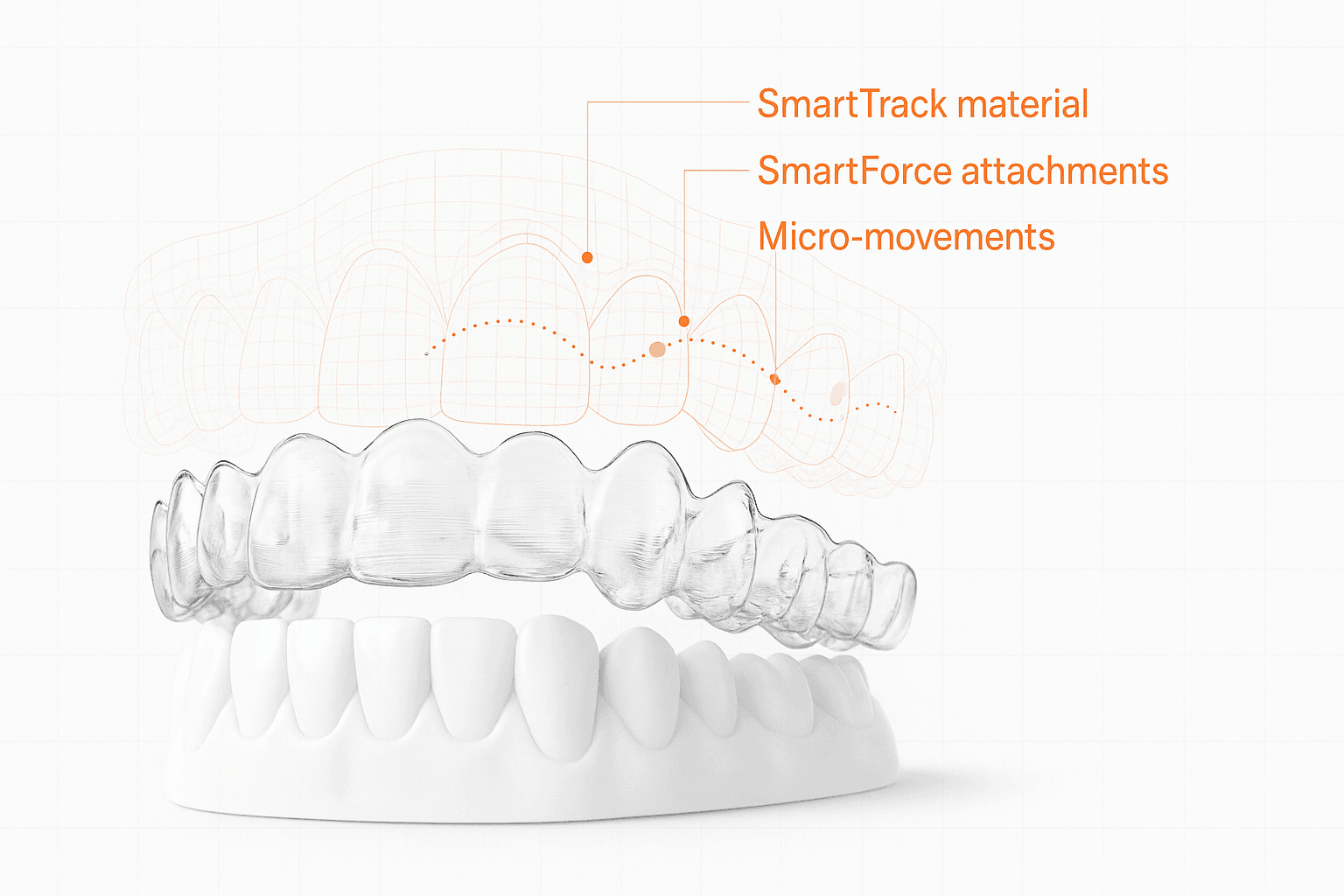 Transparent aligner over dental arch with blueprint labels: SmartTrack material, SmartForce attachments, micro-movements